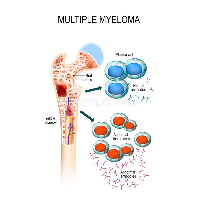Myélome multiple myélome de cellules de plasma