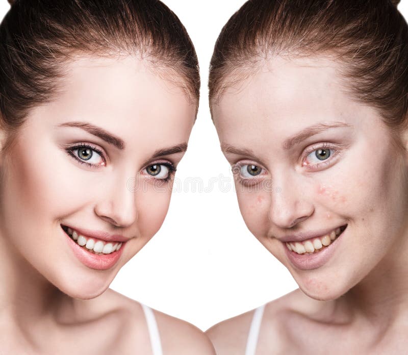 Mädchen mit Akne vor und nach Behandlung lizenzfreie stockfotografie Mädchen mit Akne vor und nach Behandlung lizenzfreie stockfotografie