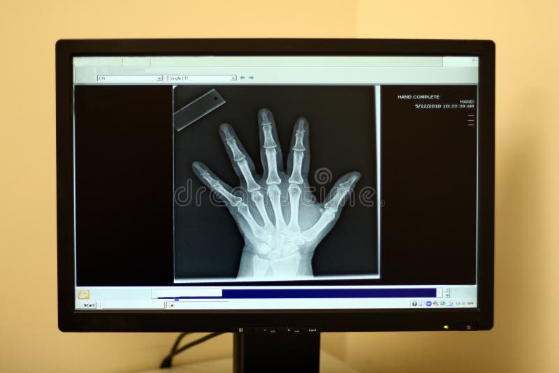 A human hand is displayed on a computer monitor in an orthopedic surgeon's office. A human hand is displayed on a computer monitor in an orthopedic surgeon's office.