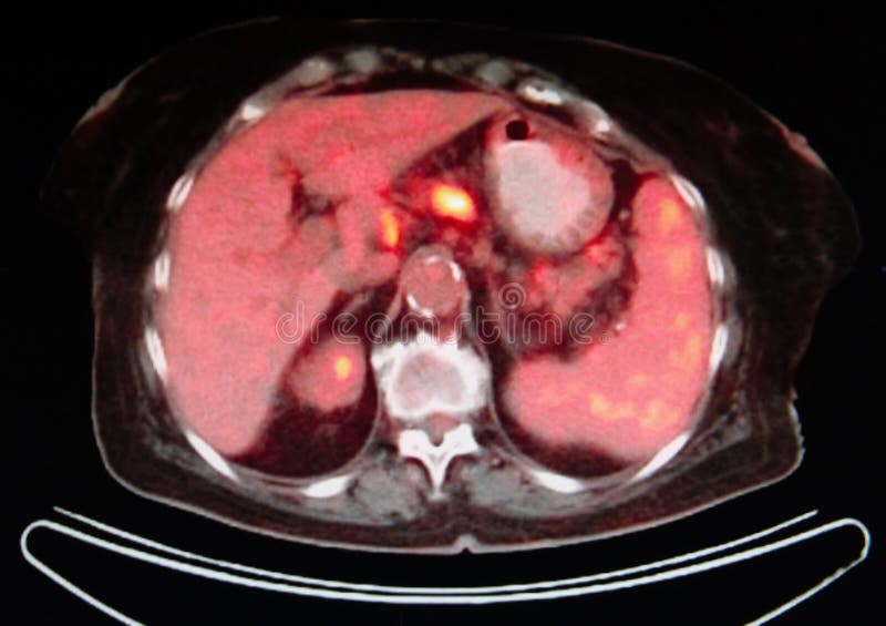 Pet/ct image on the level of liver ,red color are organs ,yellow FDG isotope ,which is very specific for oncological diagnostic. Pet/ct image on the level of liver ,red color are organs ,yellow FDG isotope ,which is very specific for oncological diagnostic