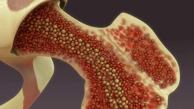 Bone marrow is the spongy tissue inside some of the bones in the body, including the hip and thigh bones. Bone marrow is the spongy tissue inside some of the bones in the body, including the hip and thigh bones.