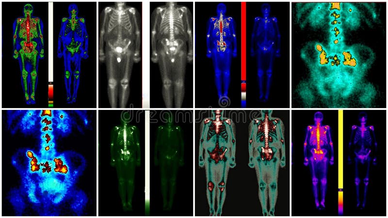 Nuclear medicine scanning of patient with prostate cancer metastasis in areas of pelvis and spine in different colors. Nuclear medicine scanning of patient with prostate cancer metastasis in areas of pelvis and spine in different colors