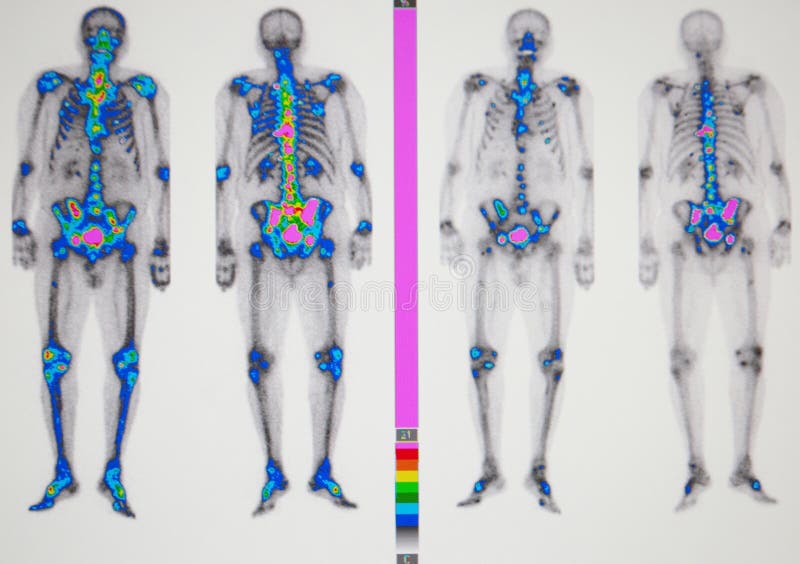 Patient refused of any operation and chemotherapy as a result of this after two years were severe spreading of metastasis to spine vertebrae pelvis and ribs. Patient refused of any operation and chemotherapy as a result of this after two years were severe spreading of metastasis to spine vertebrae pelvis and ribs