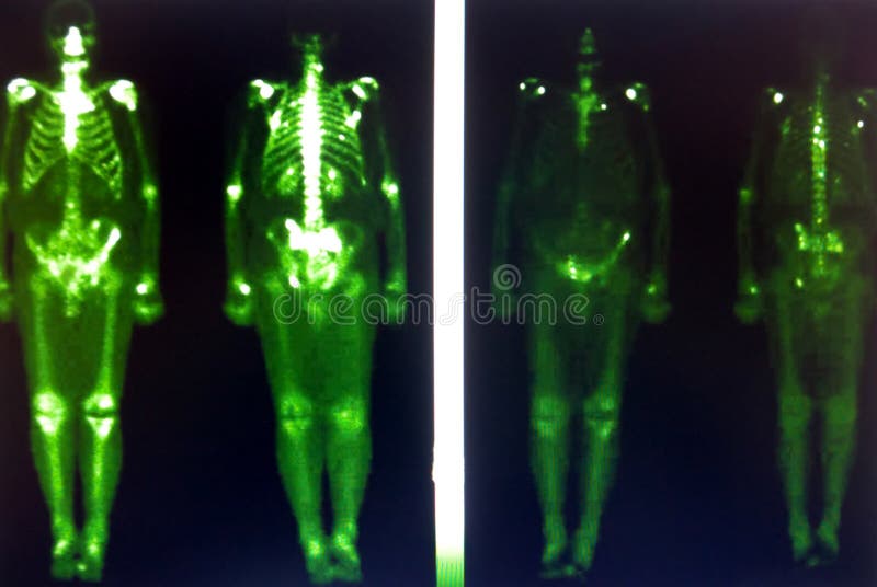 Impressive examination of nuclear medicine with proof of metastases in the area of spine and pelvis. Impressive examination of nuclear medicine with proof of metastases in the area of spine and pelvis