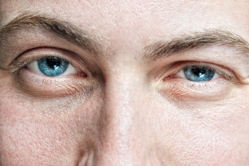 Closeup of young man's blue eyes with problematic skin and selective focus. Closeup of young man's blue eyes with problematic skin and selective focus