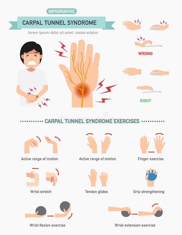 Nadgarstkowego tunelu syndrom infographic, ilustracja ilustracja wektor Nadgarstkowego tunelu syndrom infographic, ilustracja ilustracja wektor