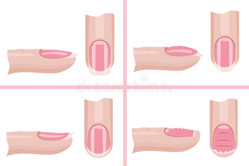 Nail care. Types of the nail plate. Illustration for the manicure guide. Hand nail care .Vector. Nail care. Types of the nail plate. Illustration for the manicure guide. Hand nail care .Vector