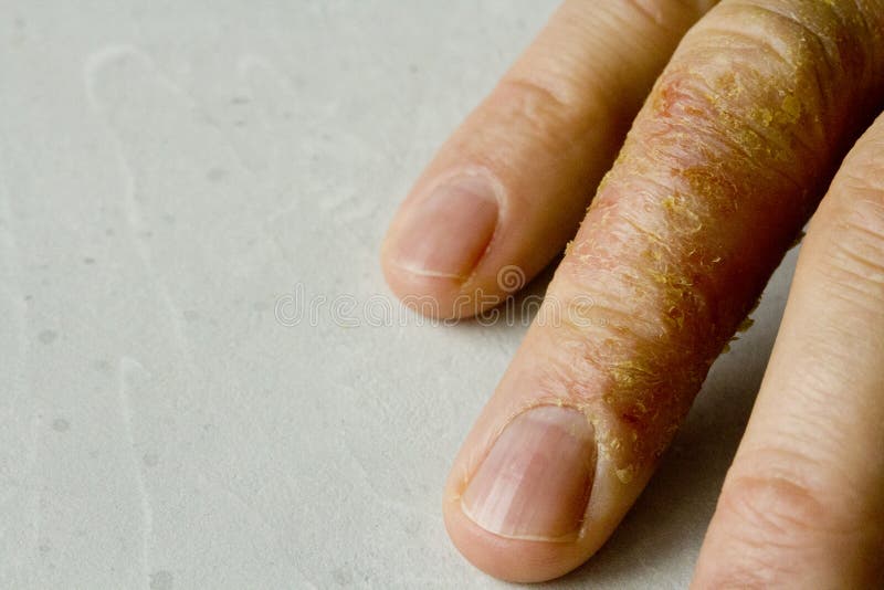 Nahaufnahme Der Ekzem-Dermatitis Auf Fingern Stockbild - Bild von krank ...