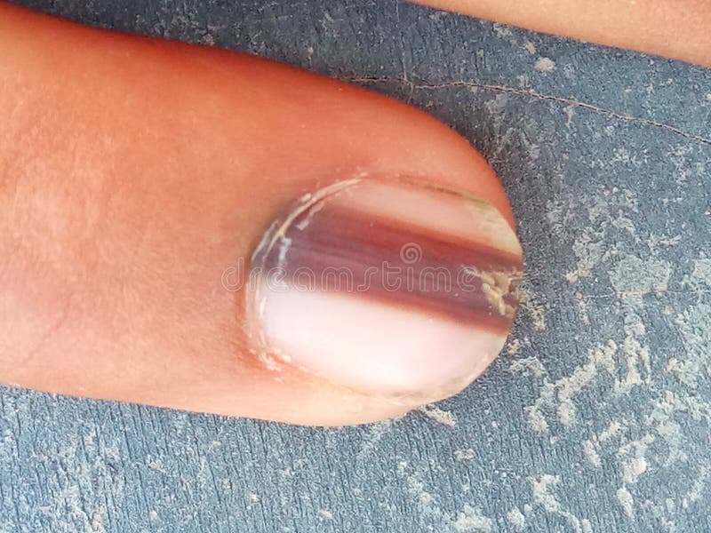 Woman With Thin Line on Nail That Looked Like Splinter Had Skin Cancer