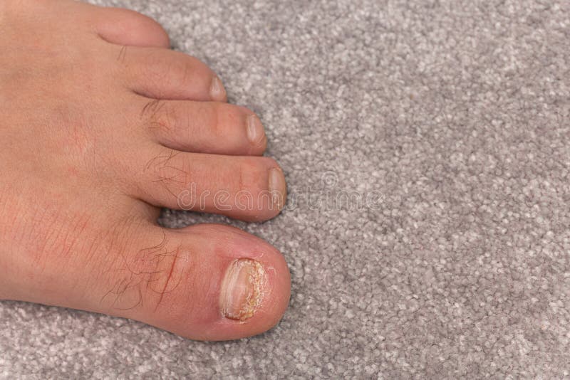 Nail Diseases on Left Mans Leg Stock Photo Image of health, care