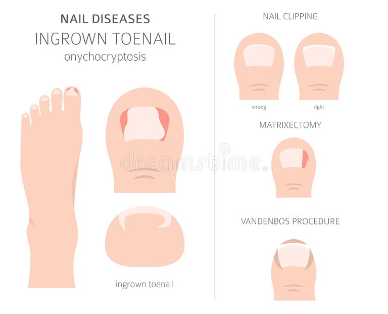 Nail Diseases Stock Illustrations – 57 Nail Diseases Stock ...