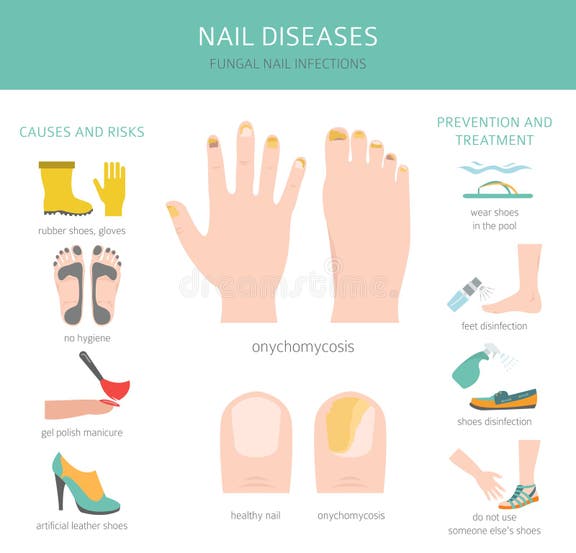 Nail Diseases Stock Illustrations – 57 Nail Diseases Stock ...