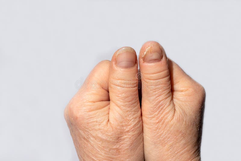Nail fungus medical human hand with magnifier Vector Image