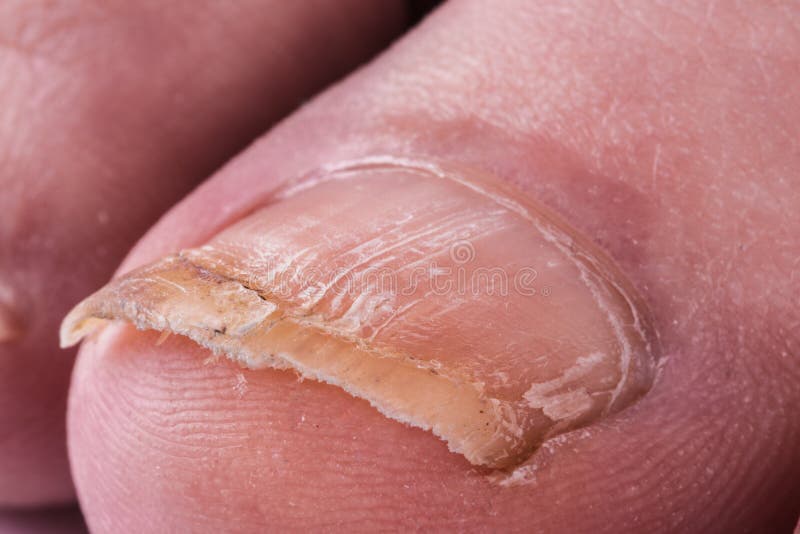 8 Ways to Safely Treat Toenail Fungus at Home