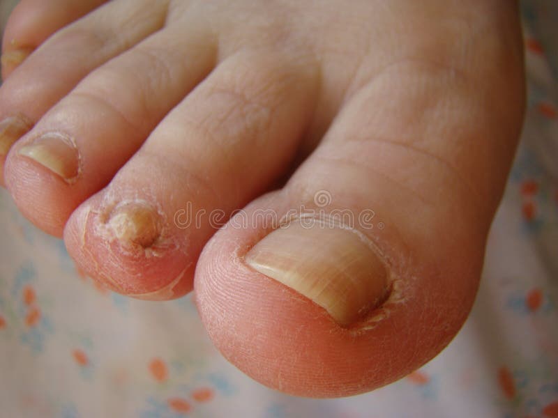 Nail fungus stock image. Image of stage, early, hygiene - 176226593 Nail fungus stock image. Image of stage, early, hygiene - 176226593