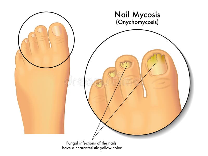 Nail mycosis