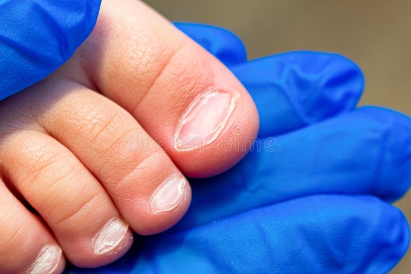 Onychoschizia: 5 Simple And Effective Home Remedies To Soothe Cracked Nails
