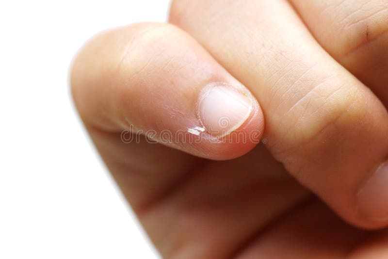 Closeup view of dry and peeling skin on a big toe Stock Photo | Adobe Stock