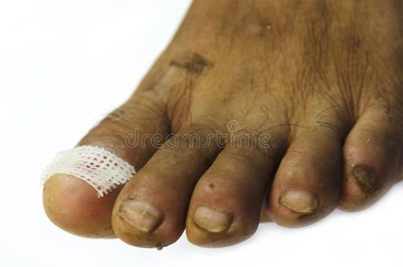 Foot dressing wound. stock photo. Image of treatment 46513428