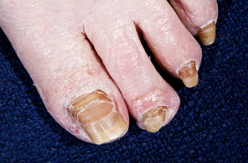 Nails Affected Human Foot Fungus, Coarsely Stock Image Image of skin