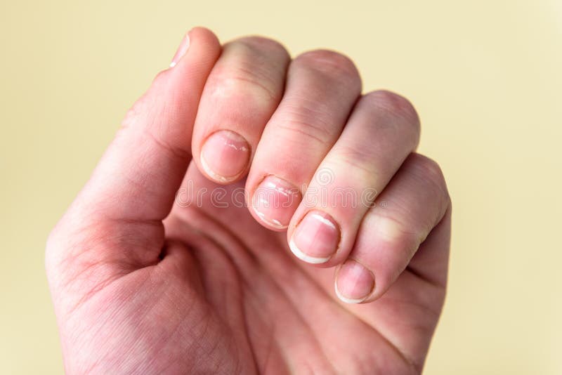 228 White Spots Nails Stock Photos - Free & Royalty-Free Stock Photos from Dreamstime 228 White Spots Nails Stock Photos - Free & Royalty-Free Stock Photos from Dreamstime