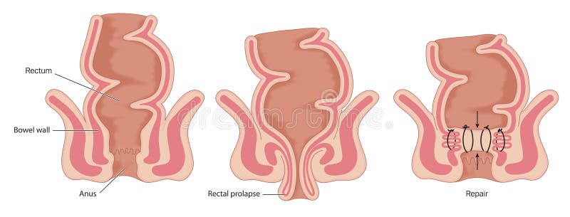 Rectal prolapse operation, showing normal bowel anatomy, prolapsed rectum and rectal repair. Created in Adobe Illustrator. Contains transparencies. EPS 10. Rectal prolapse operation, showing normal bowel anatomy, prolapsed rectum and rectal repair. Created in Adobe Illustrator. Contains transparencies. EPS 10.