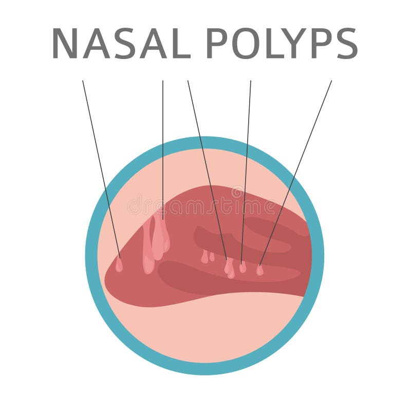 Nasala sjukdomar Nasala polyporsaker, diagnos och infographic design för behandlingläkarundersökning vektor illustrationer Nasala sjukdomar Nasala polyporsaker, diagnos och infographic design för behandlingläkarundersökning vektor illustrationer