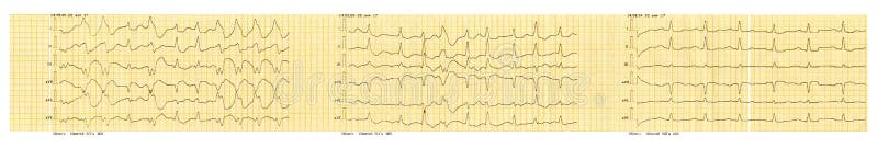 Nastro di ECG con parossismo di fibrillazione atriale e ripristino di ritmo sinusale royalty illustrazione gratis Nastro di ECG con parossismo di fibrillazione atriale e ripristino di ritmo sinusale royalty illustrazione gratis