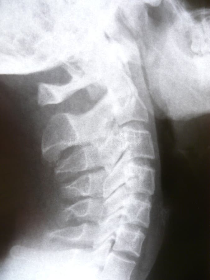 Neck bone stock photo. Image of spinal, medical, radiology - 7410334