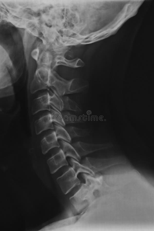 Neck and nape x-ray scan stock photos Neck and nape x-ray scan stock photos