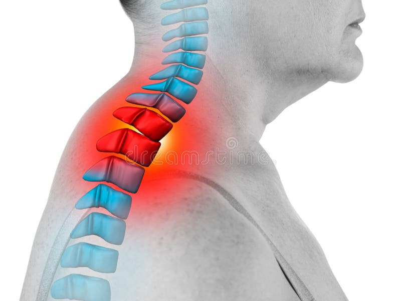 Neck pain, sciatica and scoliosis in the cervical spine isolated on white background, chiropractor treatment concept, painful area highlighted in red and blue