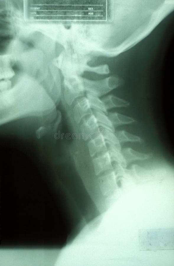 Neck xray stock photo. Image of throat, health, spine 1447062
