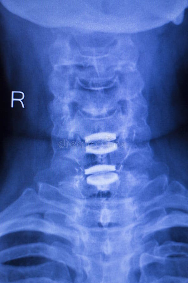 Krk a páteř a ortopedie páteřní obratel zdravotní skenovat zobrazené ortopedický titan kov implantát.