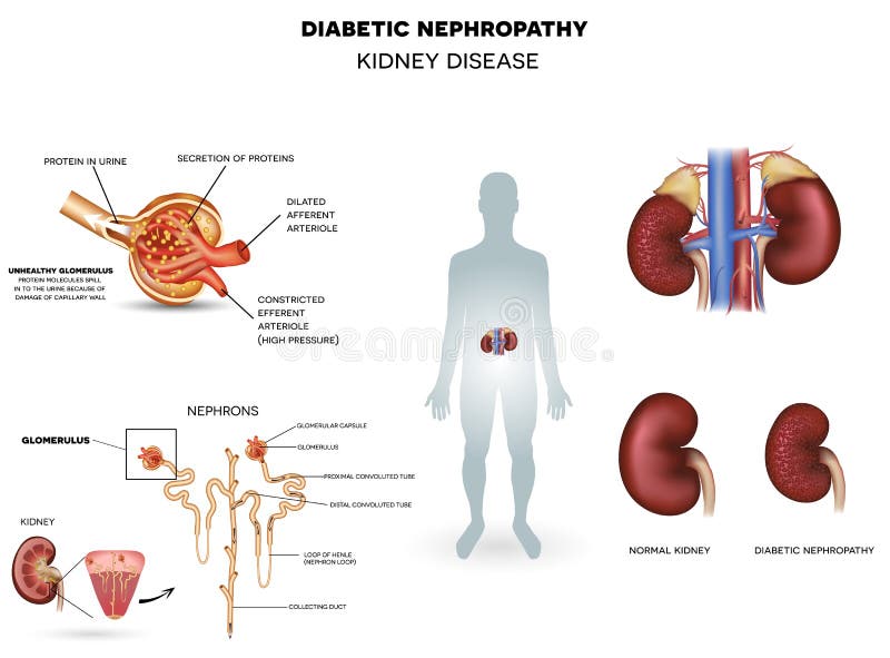 Diabetic Nephropathy, kidney disease caused by Diabetes, detailed info poster, beautiful colorful design. Diabetic Nephropathy, kidney disease caused by Diabetes, detailed info poster, beautiful colorful design.