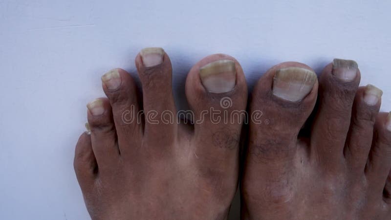 Neglected foot nails of an Indian adult with unhygienic feet conditions. Concept of self-care and personal hygiene