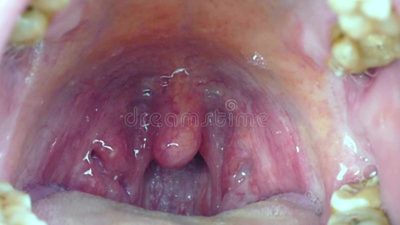 Neglected human mouth and inflamed tonsils