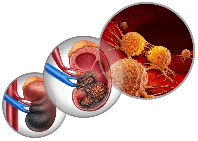 Neoplasie Renali illustrazione vettoriale Neoplasie Renali illustrazione vettoriale