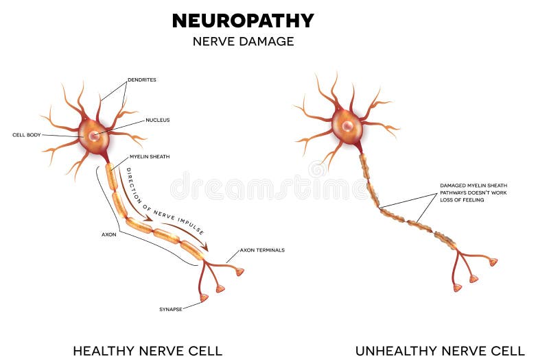 A diagram showing a healhty nerve cell and an unhealthy nerve cell