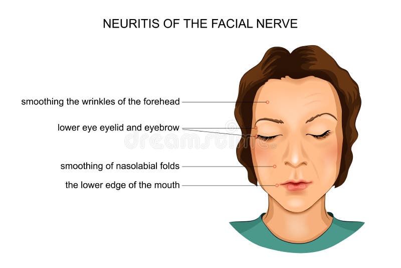 Neuritis of the Facial Nerve Stock Vector Illustration of menieres