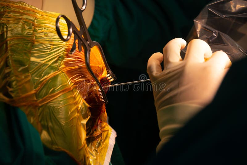 Neurosurgeon performing stereotactic biopsy in operating room