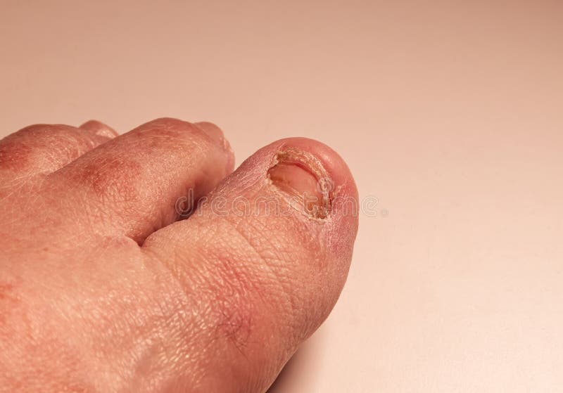 New Toenail in the Process of Regrowing after Trauma Stock Image