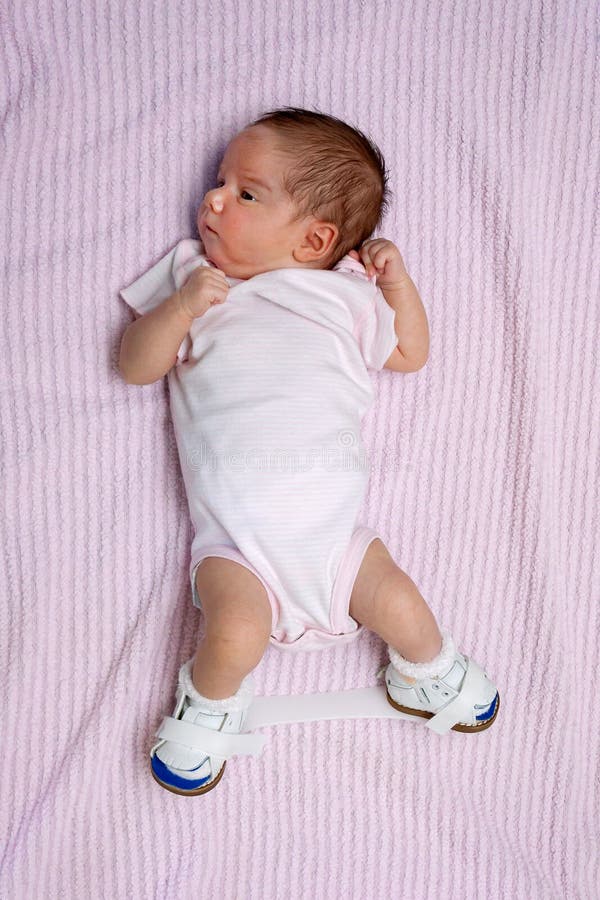 Newborn With Club Foot Wearing Orthopedic Shoes Stock Photo Image Of Congenital Footwear