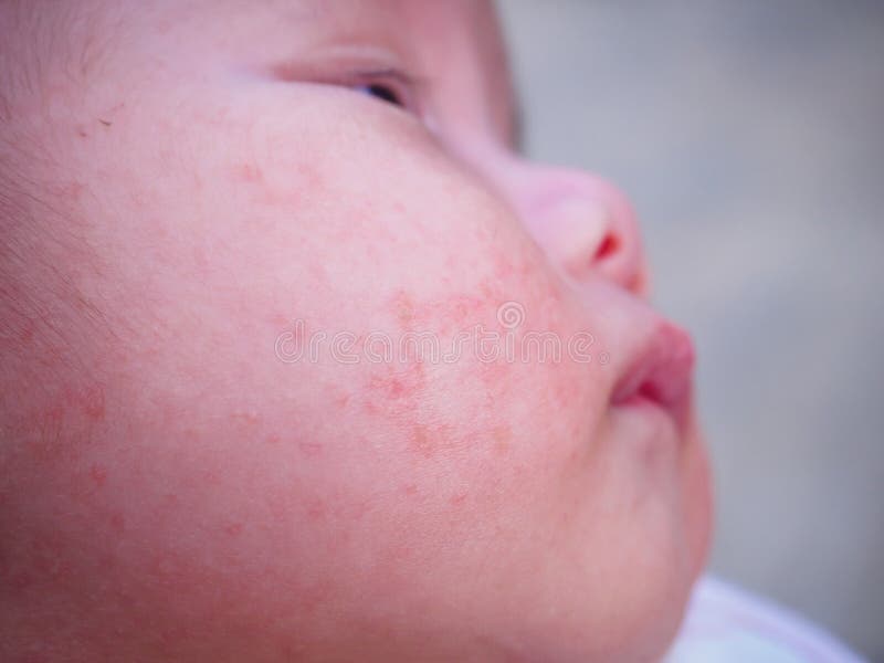 Baby with Dermatitis Problem of Rash. Allergy Suffering from Food