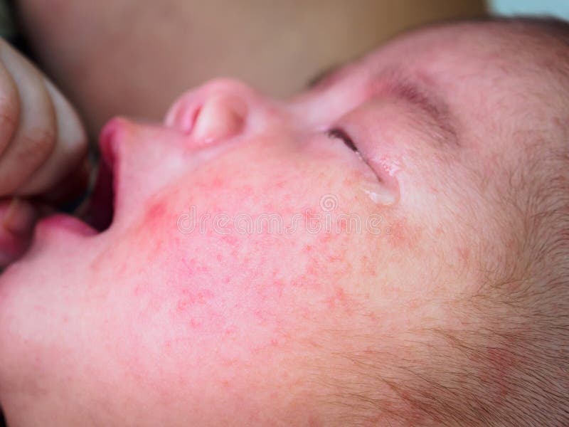 Newborn Baby with Allergy on Face Stock Image Image of food