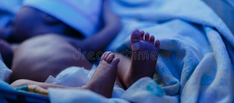 newborn baby lying under blue lamp because of bilirubin, phototherapy, he has jaundice