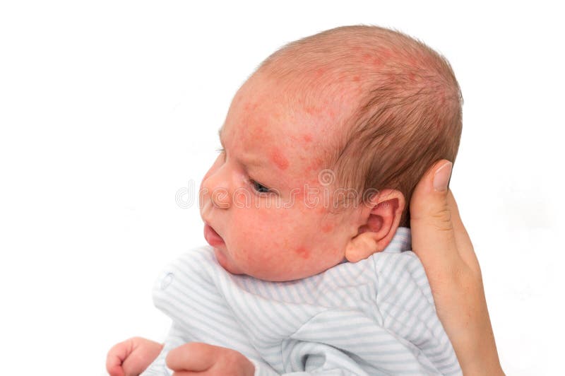 Newborn Baby with Skin Rash. Allergic Reaction after Birth Stock Photo ...