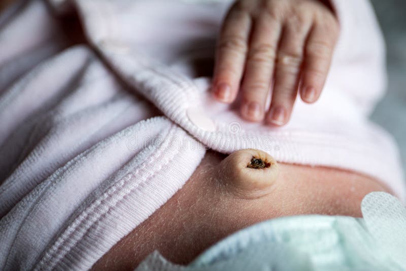 Newborn Hand and Navel with Umbilical Cord Just Fallen Off, Umbilical  Hernia in Infants Stock Image - Image of innocence, born: 260226243