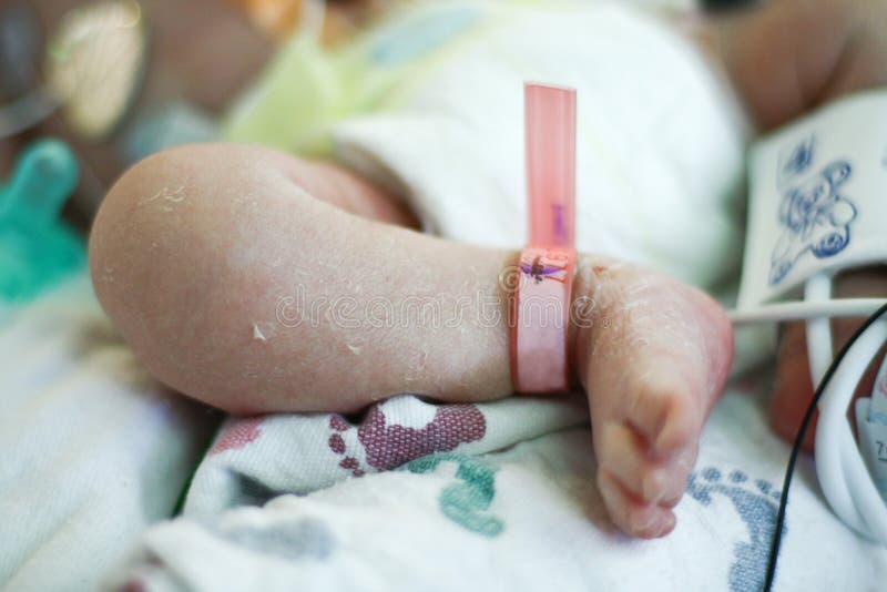 Newborn s leg and foot hospitalized in NICU