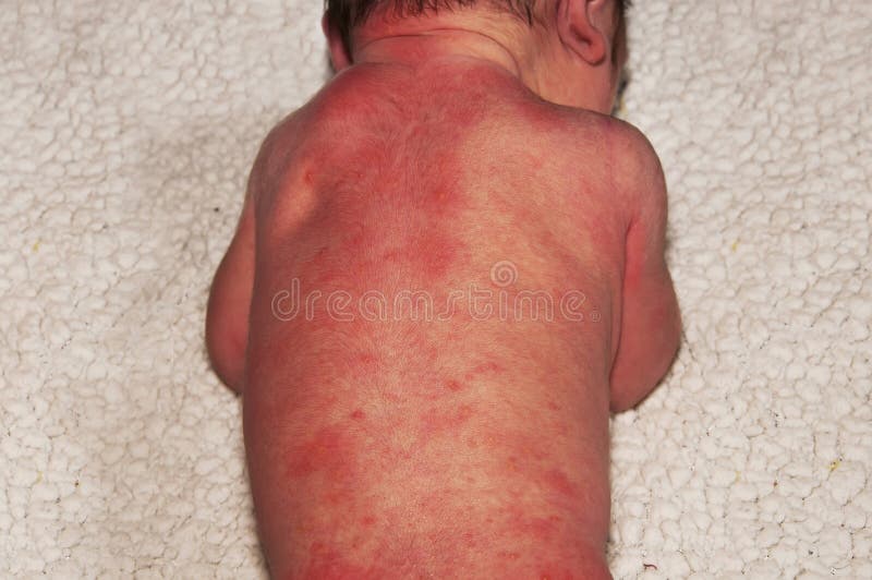 Newborn with severe baby acne possibly from an adverse reaction to shots given at birth. Allergic reaction, body trying to