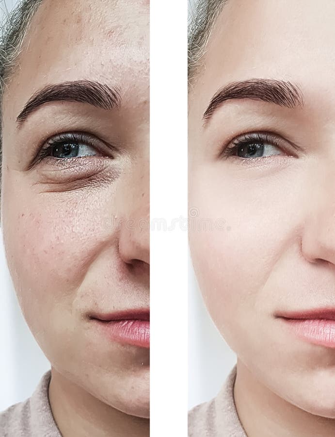 girl beauty wrinkles eyes before and after cosmetology procedures royalty free stock photos girl beauty wrinkles eyes before and after cosmetology procedures royalty free stock photos
